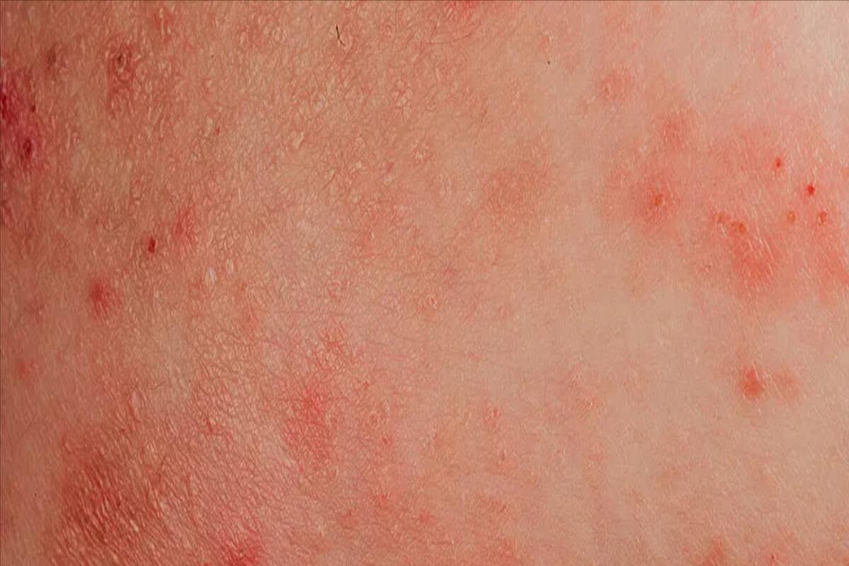 毛囊炎久治不愈可能是糖尿病吗,毛囊炎久治不愈说明有癌症