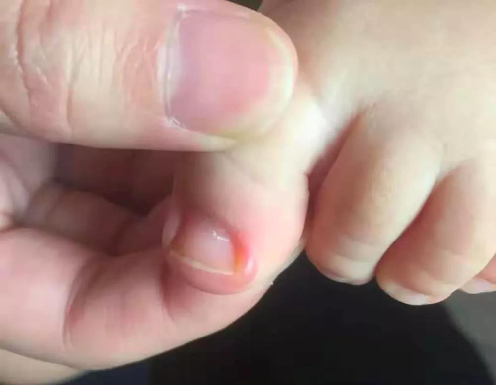 宝宝脚趾甲长到肉里怎么办,宝宝的脚趾总是弯着
