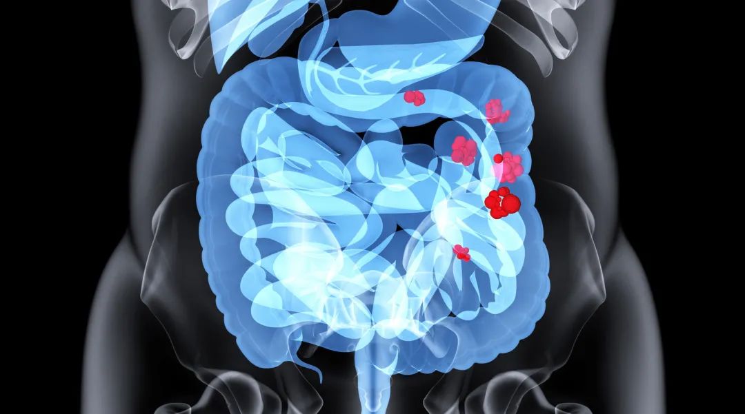 cea和ca199能查出来癌症吗,癌症检查指标ca199你了解多少