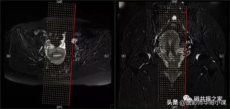 「精品课件」带大家看看,磁共振子宫MRI要如何扫描?