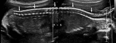 胎儿脊柱超声正常表现是怎样的,胎儿脊柱的超声诊断
