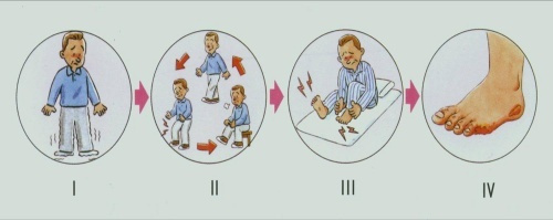 腿疼血管堵塞是怎么回事,腿疼血管堵