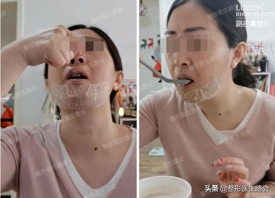 垫下巴手术流程,垫下巴手术的全过程