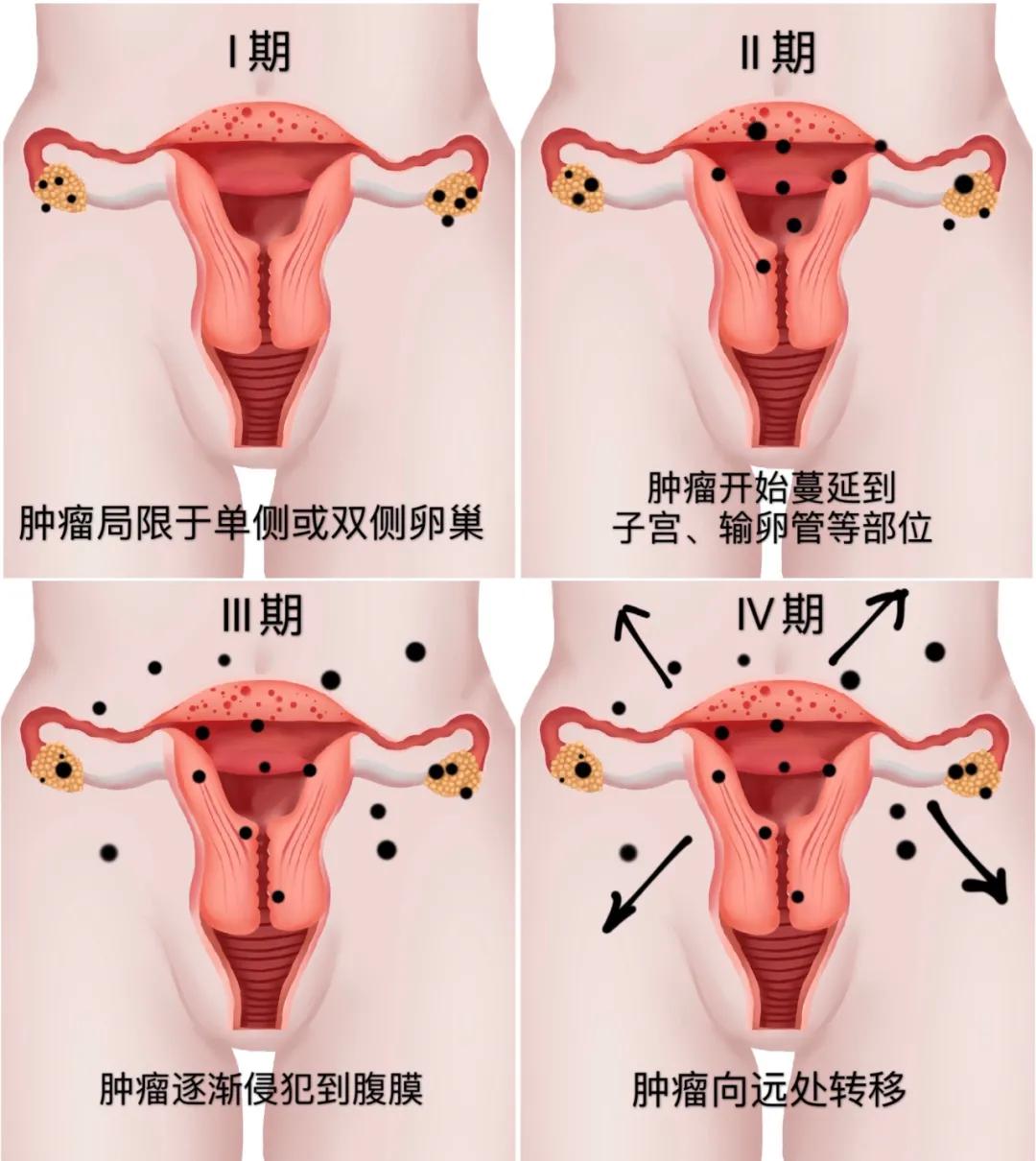 卵巢癌的诊断和治疗课件,卵巢癌治疗科普