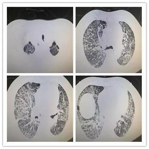 罕见病误诊的真实案例,误诊漏诊导致病人肿瘤癌变