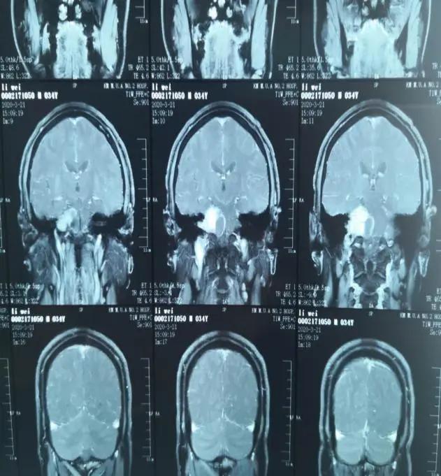 30岁男子右耳堵塞听力下降,46岁男性突然一只耳朵听力下降