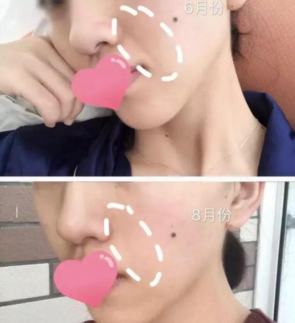 硬刚女皇龙妈也扛不住法令纹,2条沟壑让人心疼,贴一贴就消了