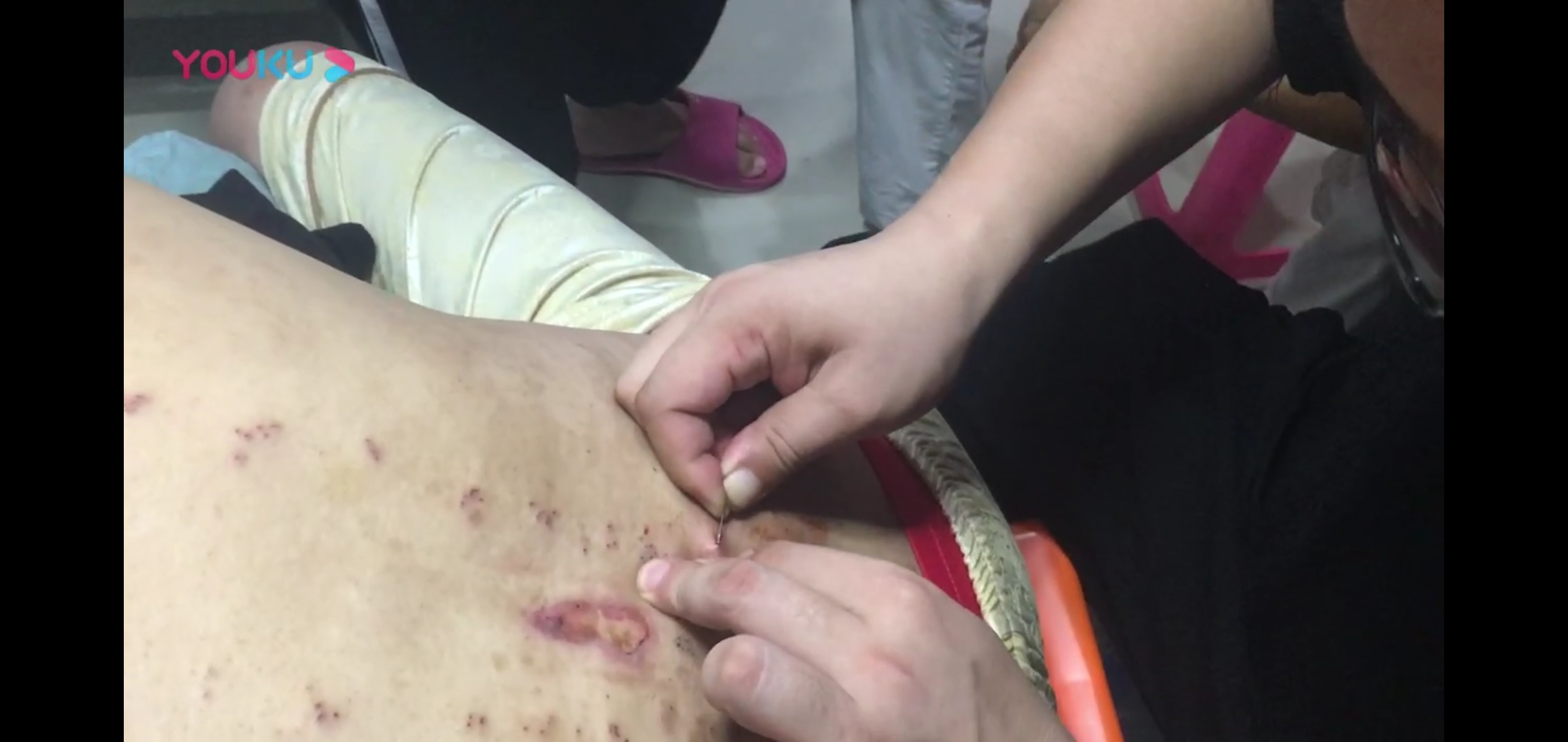 网球肘的针灸治疗方法,网球肘的针灸方法董氏