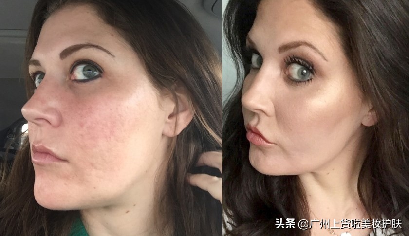 paa美容抗衰和光子嫩肤哪个好,美容光子嫩肤有什么作用