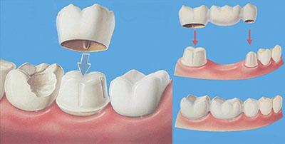 牙缝大该怎么补救,剔牙造成牙缝大怎么补救