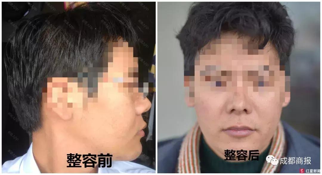 确定不是搞笑？男子花1.2万隆鼻后竟能晃动…美容院：属正常误差