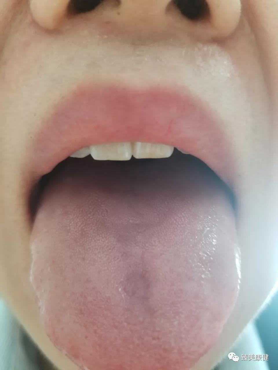 胃苓丸加什么药治湿疹,除湿胃苓丸治疗湿疹