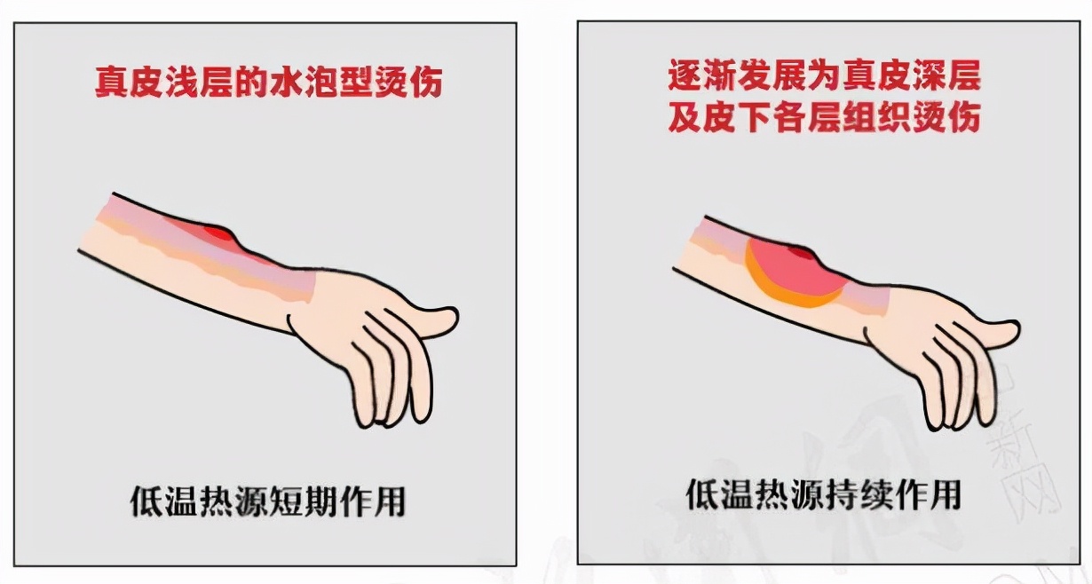 烫伤女生*处私**“黑科技卫生巾”,究竟什么原理?到底有没有危害?