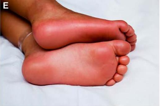 给儿童带来相对长时间发热的「川崎病」该如何治疗？