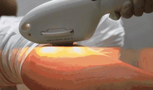 拔毛止痛的方法,脱毛太疼怎么办