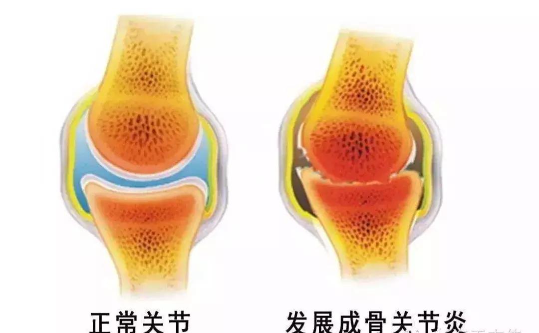 膝盖疼痛千万别忍着！骨科大夫教你搞定膝关节炎