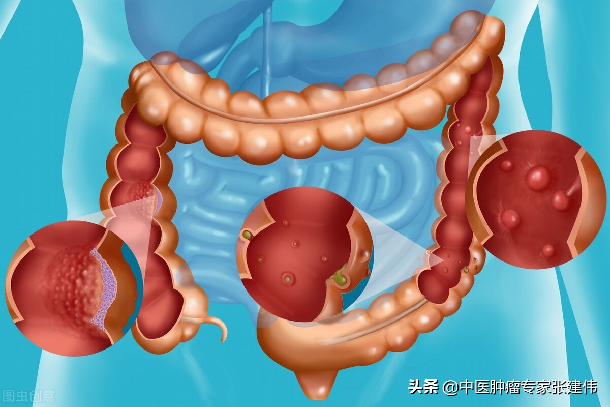 肠息肉手术后注意事项是什么啊,肠息肉手术后应注意事项