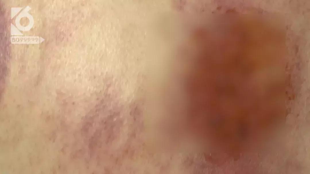 女性湿气太重拔火罐有用吗,拔火罐后有水泡是烫伤还是湿气