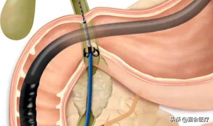 取胆管结石不用开刀，ERCP神奇在哪里？