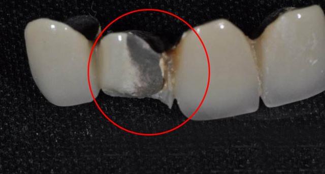 烤瓷牙崩瓷了怎么办,烤瓷牙崩瓷概率高吗