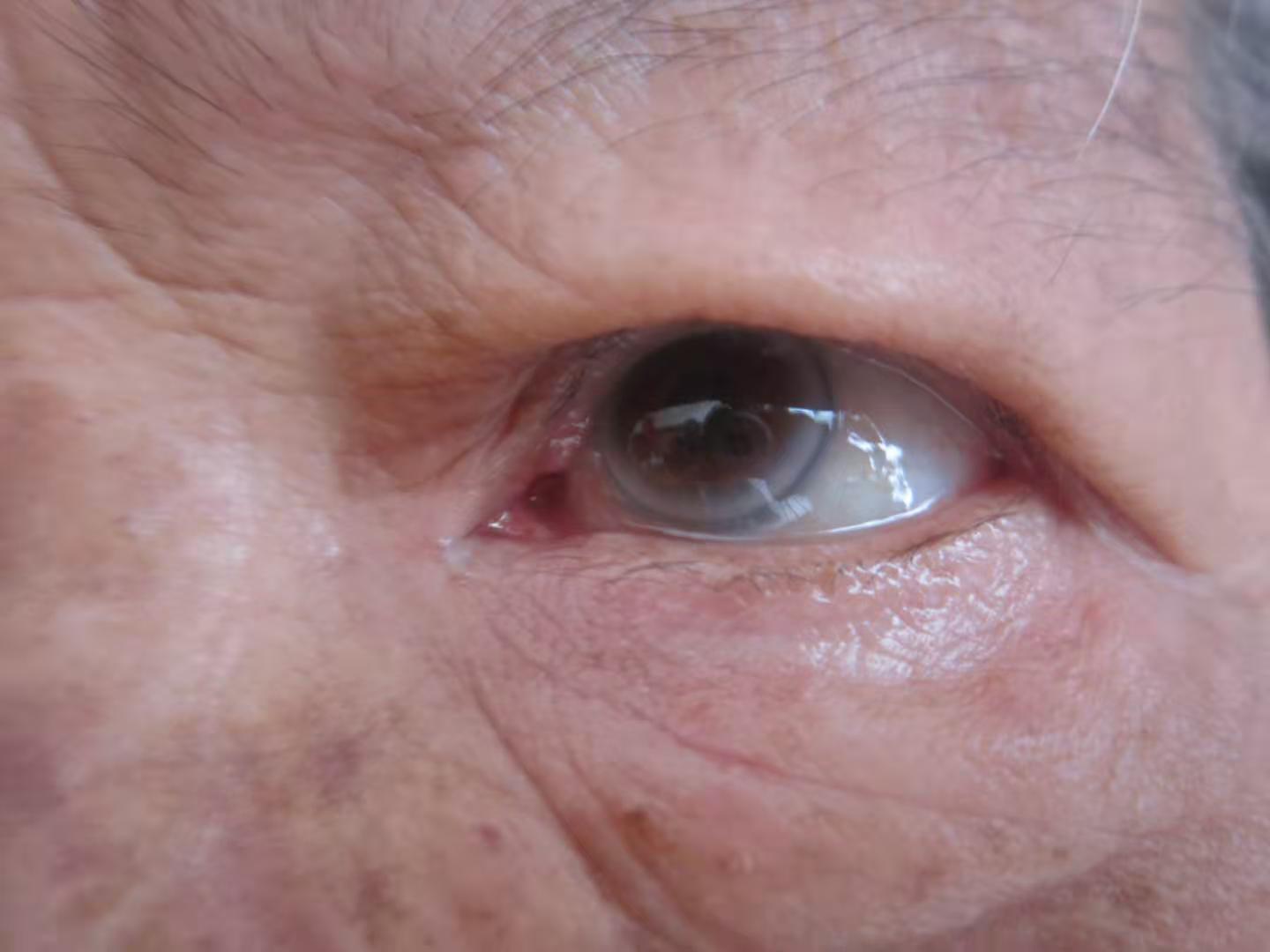 慢性肉芽肿病会导致反复感染的发生，需尽早进行相应治疗