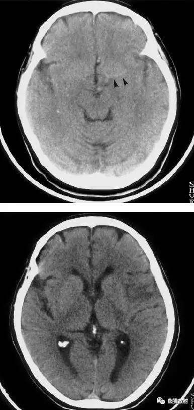 各部位脑梗死ct影像讲解,脑梗死ct影像最简单的是什么表现