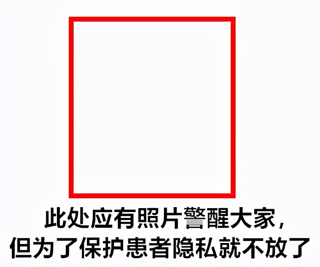 打玻尿酸多久可以移植自体脂肪,打玻尿酸整形有危险吗