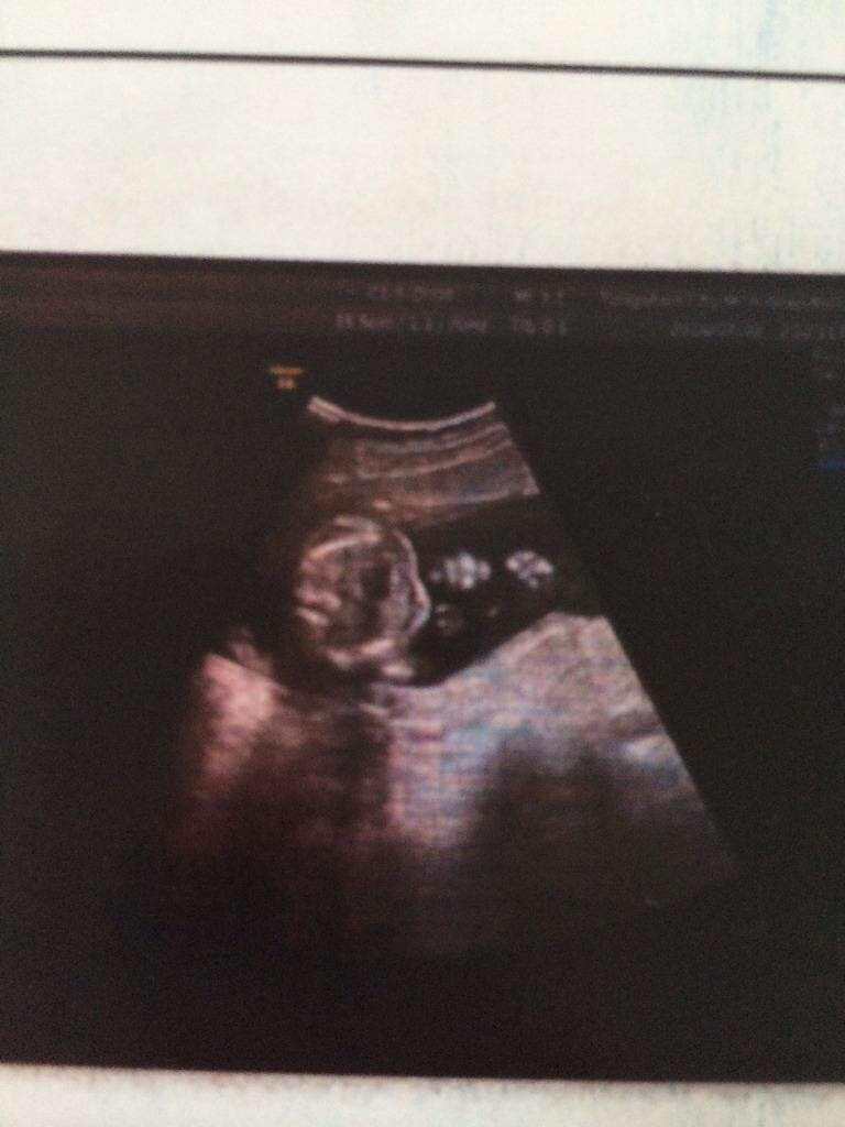 18周胎儿头围和腹围一样的正常吗,孕18周的宝宝真实模样