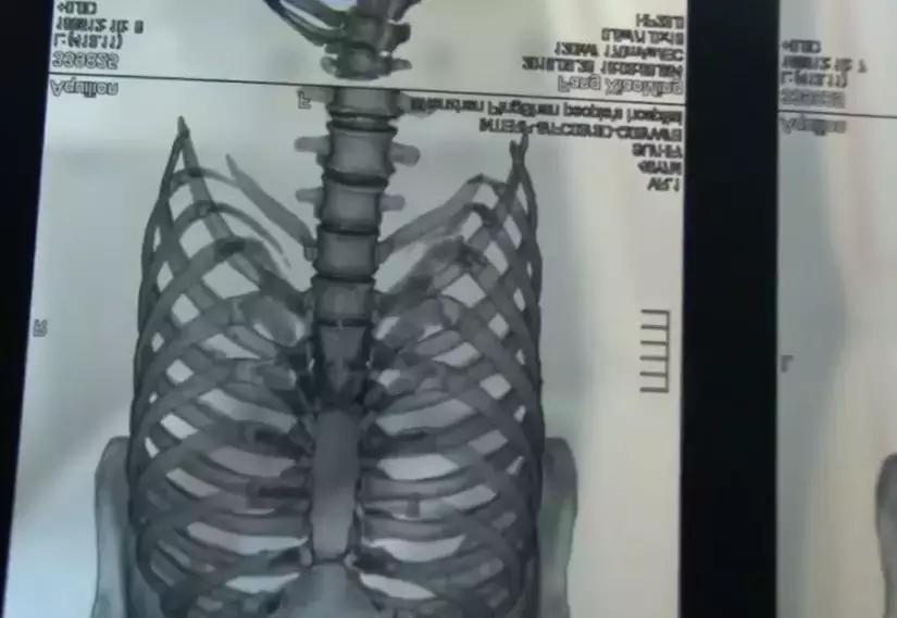 男子深夜踩住没盖好的井盖，井盖突然翘起撞到胸口，导致肋骨断裂