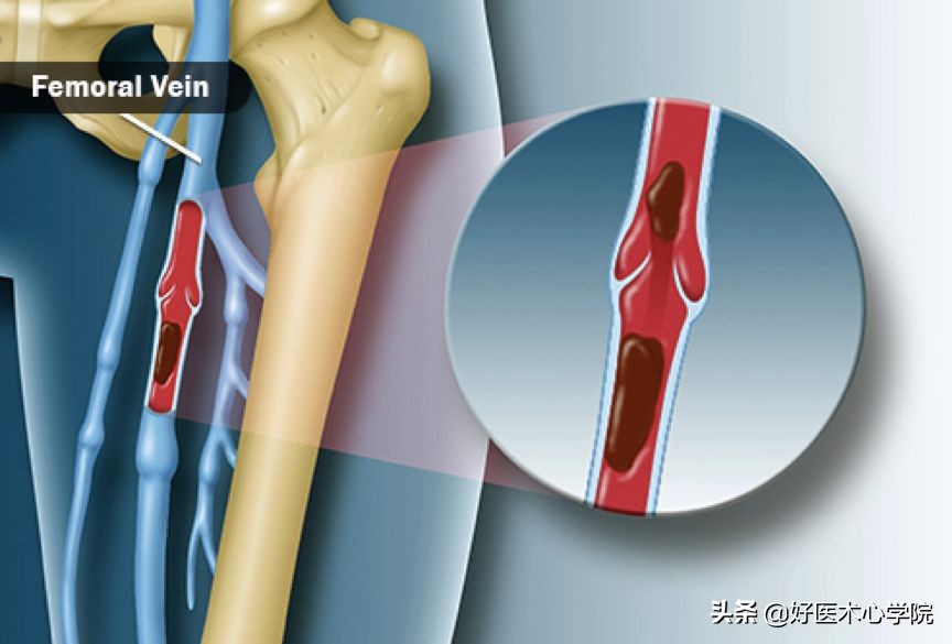 最常见的血栓类型是,最致命血栓视频