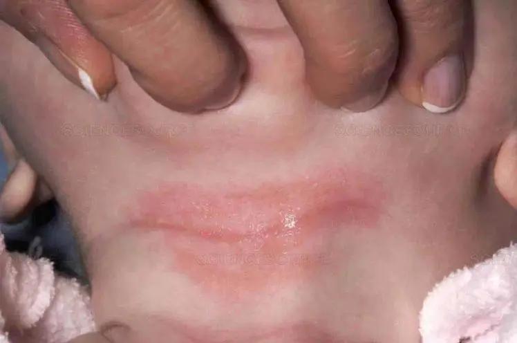 小孩起像痱子一样疹子怎么处理,小孩长像痱子一样的疹子是什么