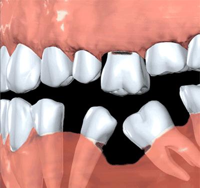 武汉29岁女子整牙掉一半,女人35六岁就开始掉牙了