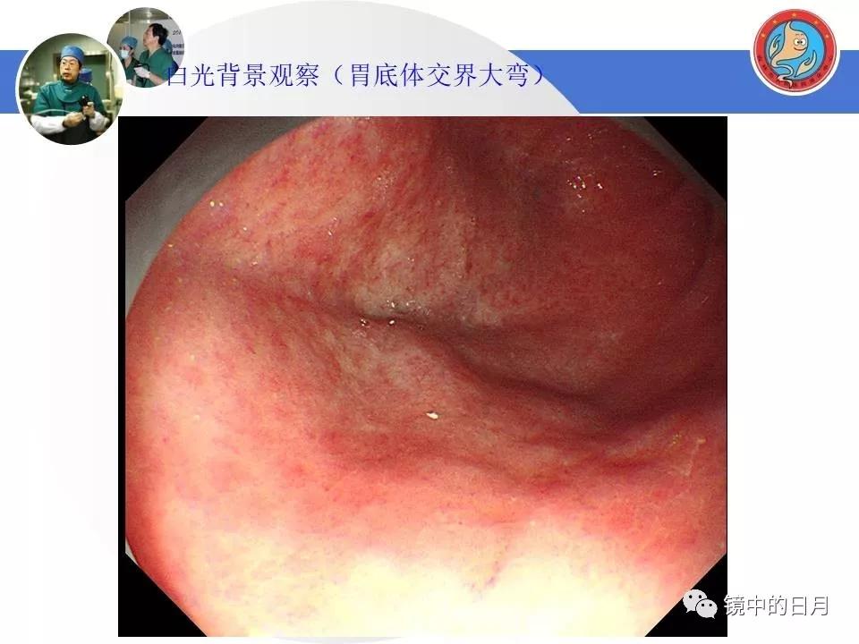 低分化胃癌早期时候做内镜手术吗,早期胃癌内镜手术后追加外科手术