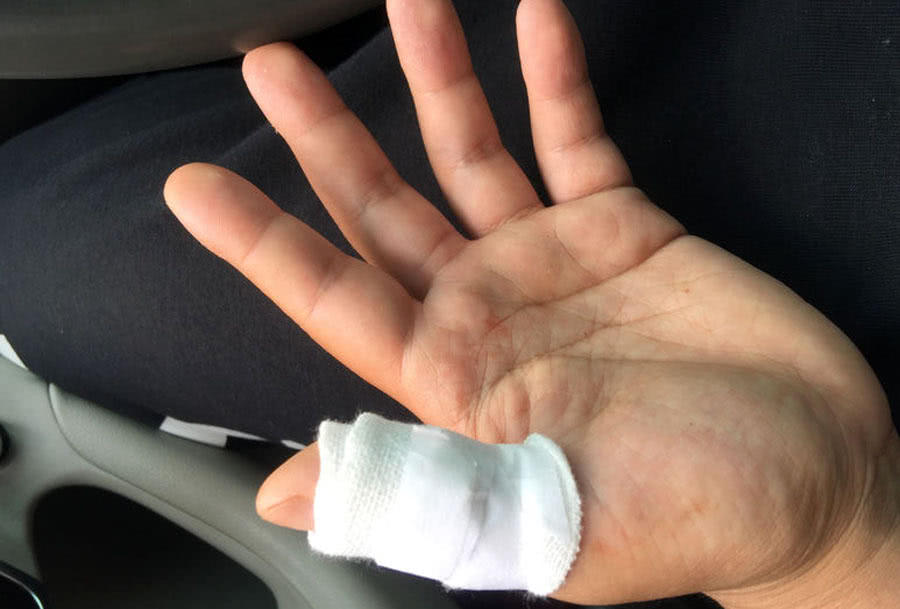 钓鱼鱼钩进喉咙里怎么办,野外钓鱼鱼钩刺入手指怎么办