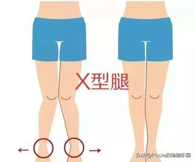 膝盖内扣扁平足怎么矫正,膝盖内扣怎么矫正腿型13岁