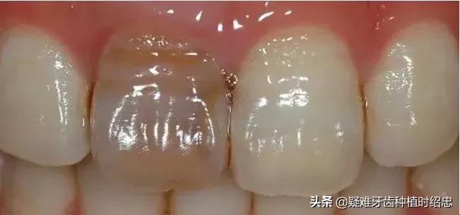 大熊猫根管治疗,戴牙冠真的能保护好正常基牙吗