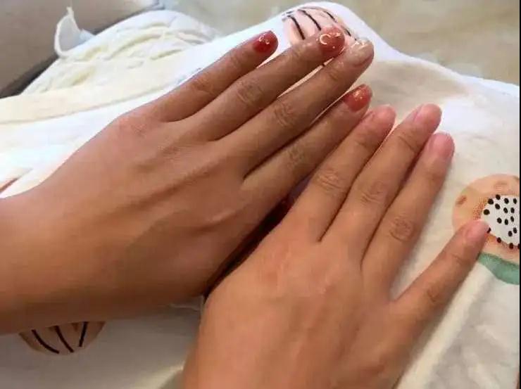 什么会导致手变黑,让手变白而且能脱皮