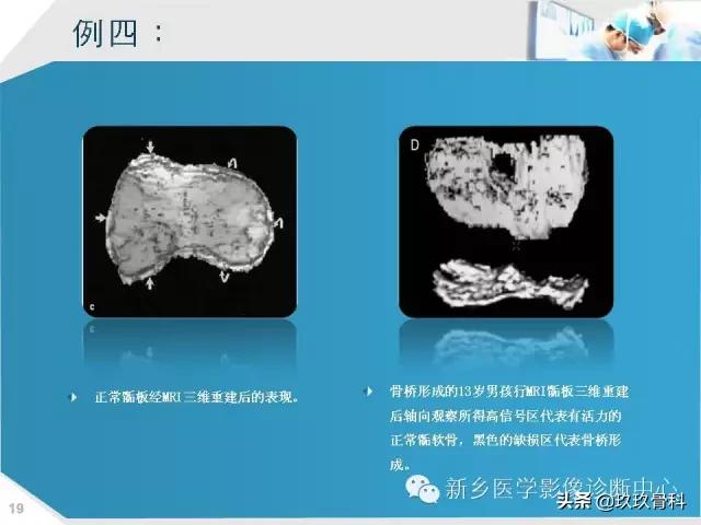 骨骺损伤x线表现,骨骺损伤磁共振表现