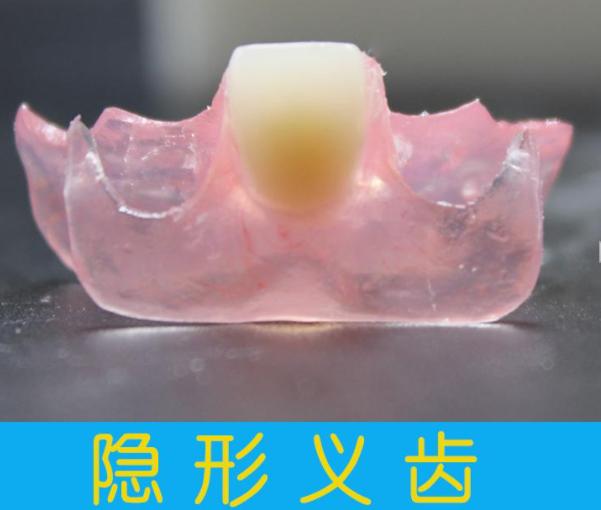 有舒服的活动义齿吗,装一颗活动义齿最舒服的是哪一种