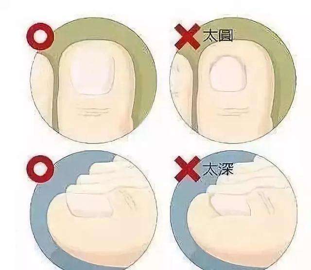 甲沟炎怎么初期治疗才能彻底根除,甲沟炎患者有多痛苦