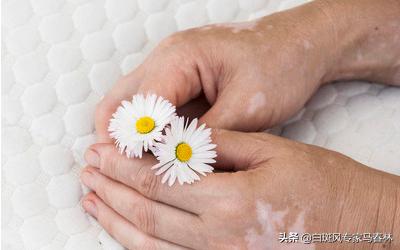 治疗白癜风是真的吗,治疗白癜风的药为什么都伤肝