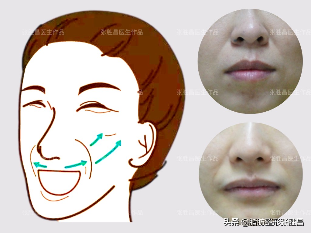 笑久了有法令纹,笑一笑减少法令纹