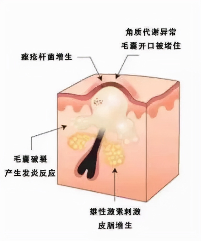 疥疮丘疹的成因,斑丘疹状皮损是什么病