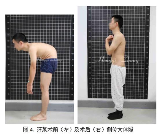 湘雅医院为重度强直性脊柱炎后凸畸形患者恢复“直立”人生