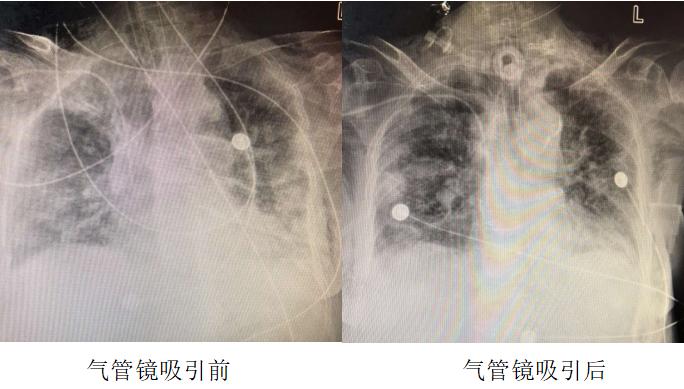 血氧突然下降又恢复正常,血氧正常可是总觉得上不来气