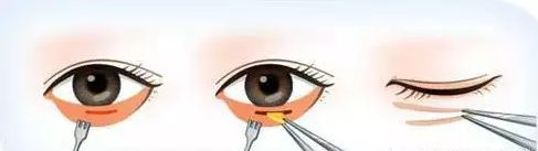 有眼袋怎么办按摩去眼袋,去眼袋眼霜真能去眼袋吗