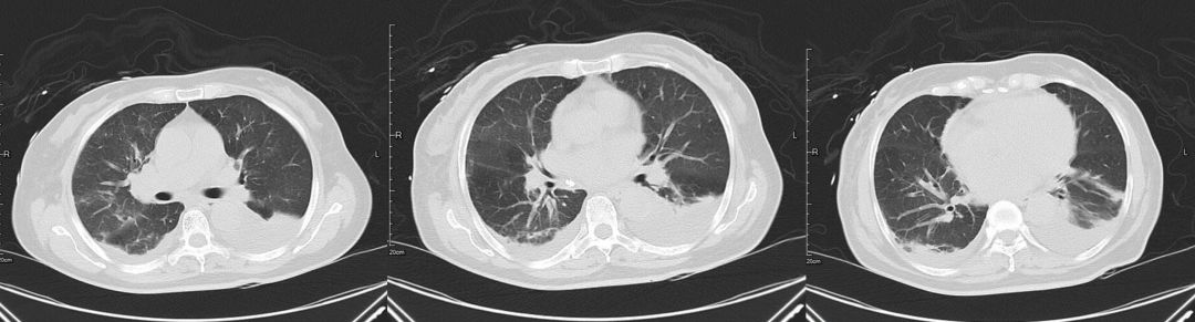 肺部阴影不是感染的代名词，这例患者差点误诊为社区获得性肺炎
