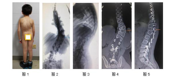 特发性脊柱侧凸的康复治疗方法,先天性脊柱侧凸