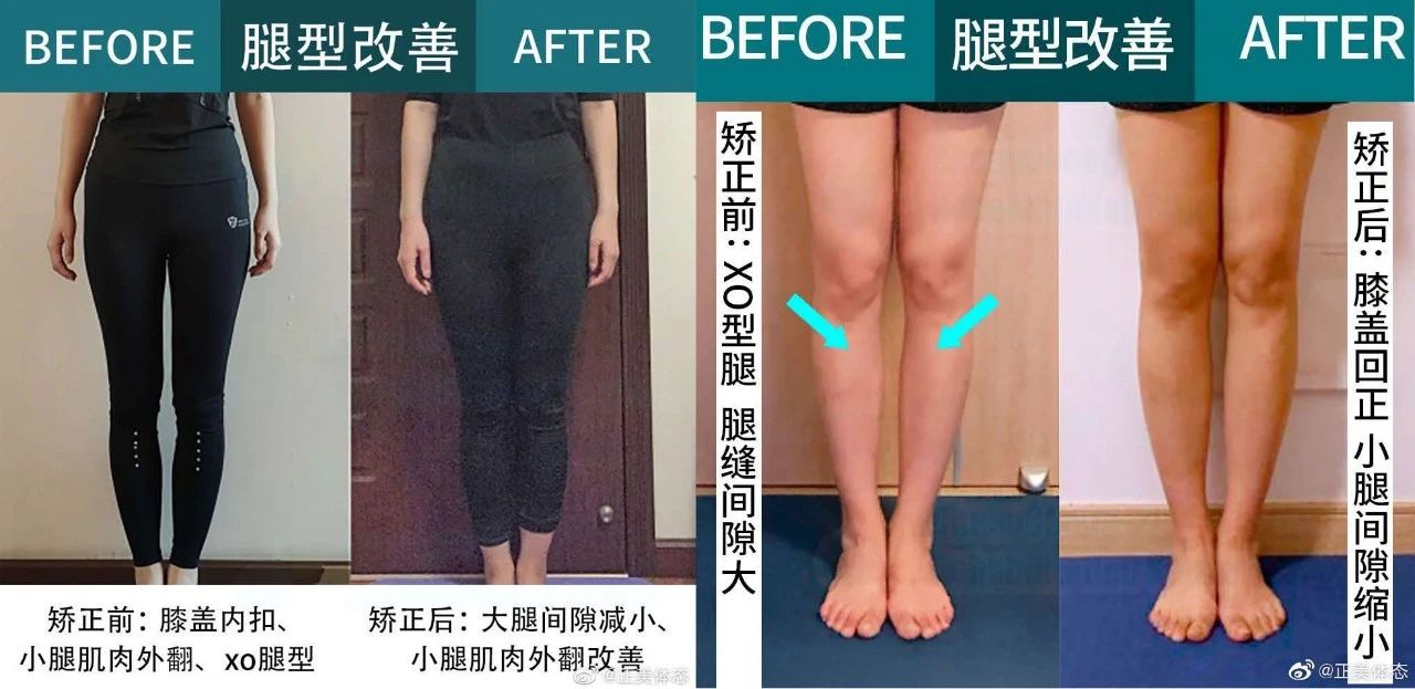 两腿并拢大腿有缝隙怎么练改善,双腿并拢时大腿处有缝隙怎么办