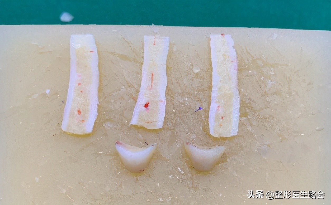 想做隆鼻的女孩,肋软骨填充鼻基底会拉长人中吗